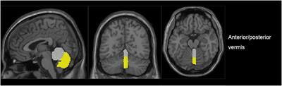 Decreased Functional Connectivity of Vermis-Ventral Prefrontal Cortex in Bipolar Disorder